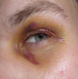 کمک های اولیه - کبودی چشم